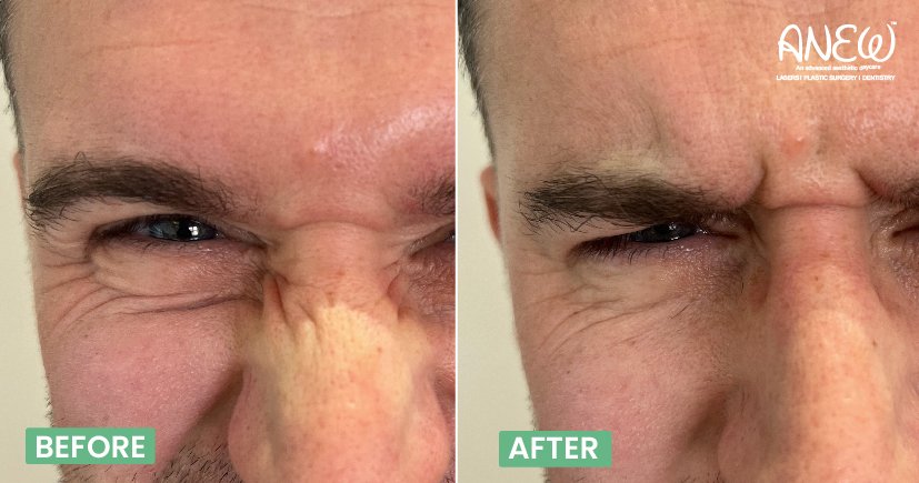 Best botox in bangalore